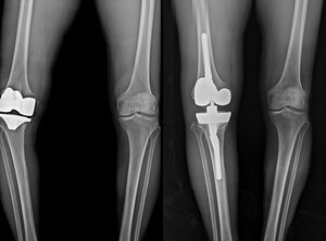 연세사랑병원, 무릎 인공관절 재수술 1천례 달성